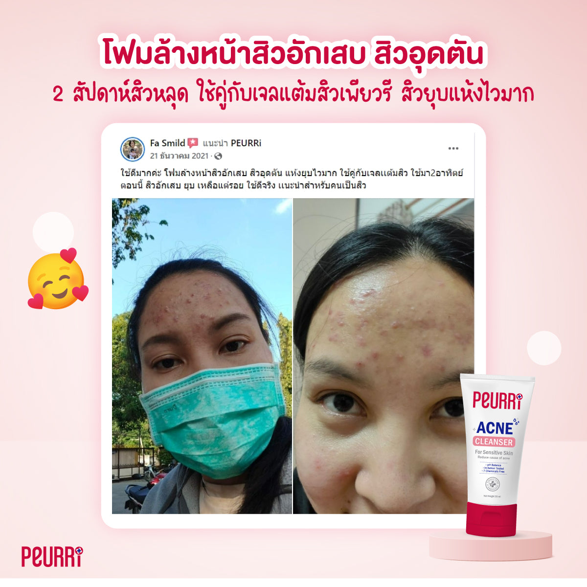 PEURRI Acne gel 8g. Free Cleanser 10ml